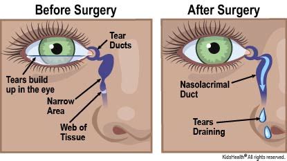 tear duct obstruction test|blocked tear duct repair.